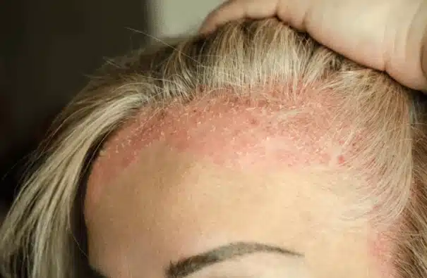 Illustration du psoriasis du cuir chevelu