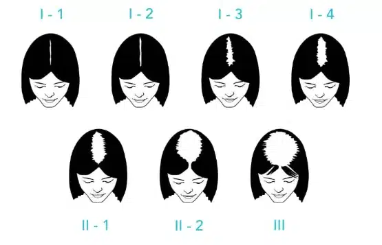 Illustration des stades d’affinement de la chevelure féminine