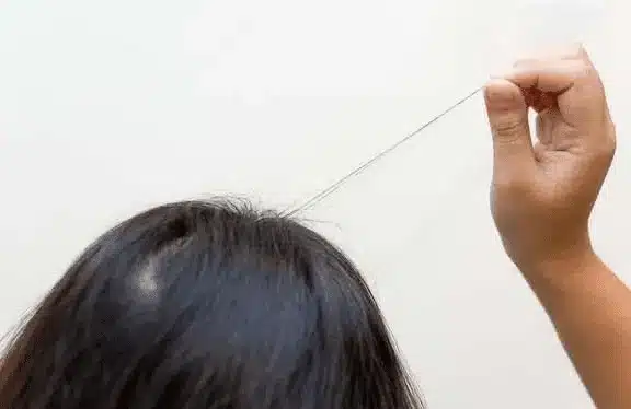 Illustration d’une perte de cheveux pouvant évoquer un arrachage répété